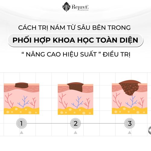 CÁCH TRỊ NÁM TỪ BÊN TRONG TOÀN DIỆN VÀ NÂNG CAO HIỆU SUẤT ĐIỀU TRỊ